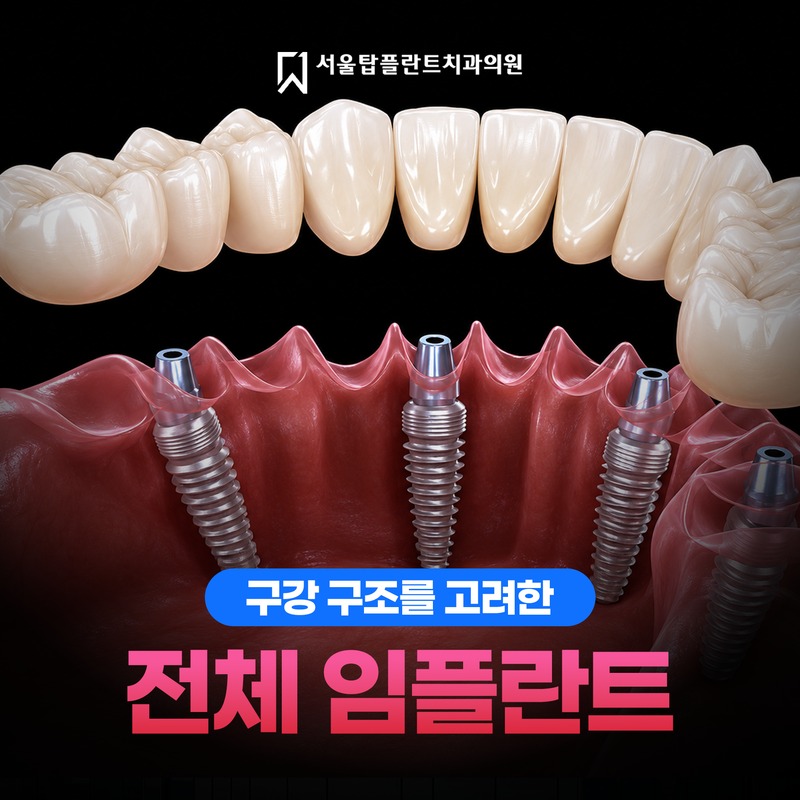 임플란트