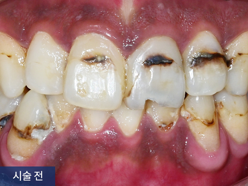 충치치료 사례