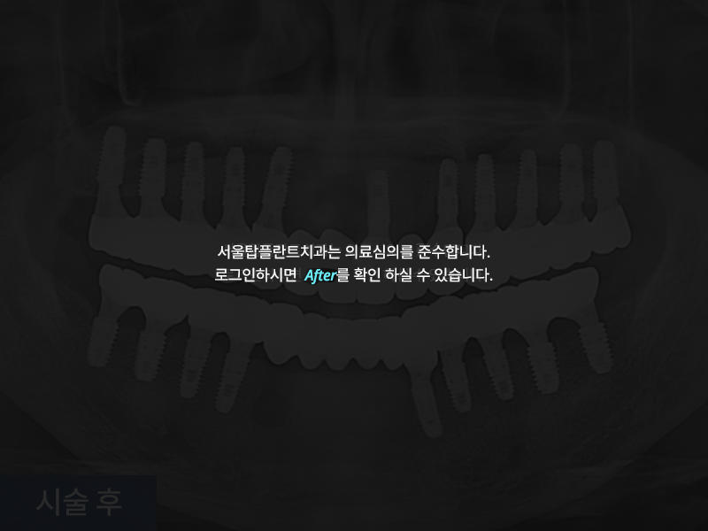 전악 임플란트 사례