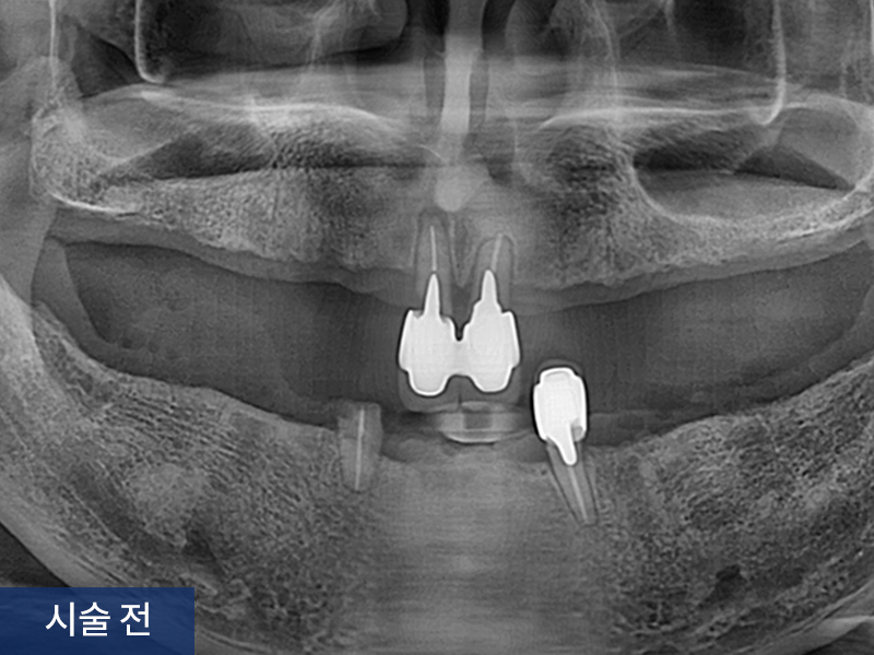 전악 임플란트 사례