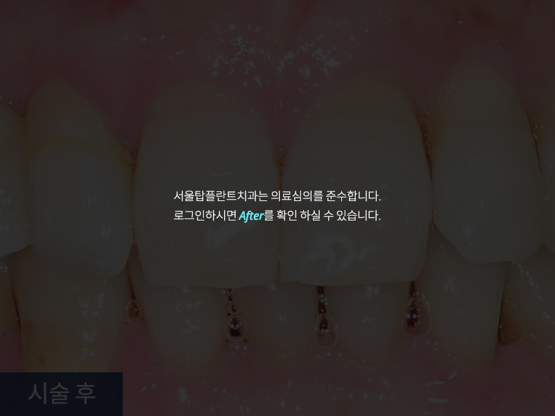 치아미백 사례