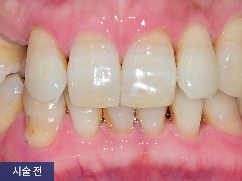 치아미백 사례