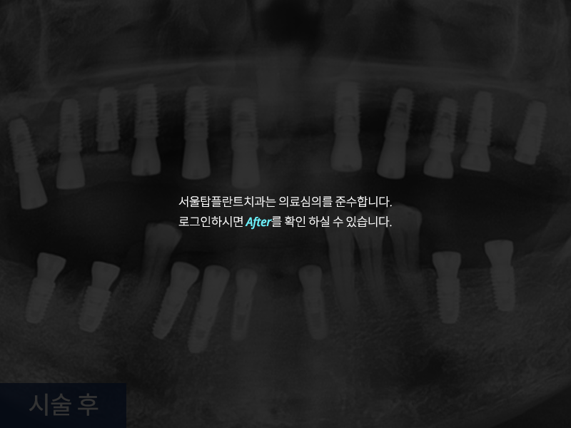 전악 임플란트 사례