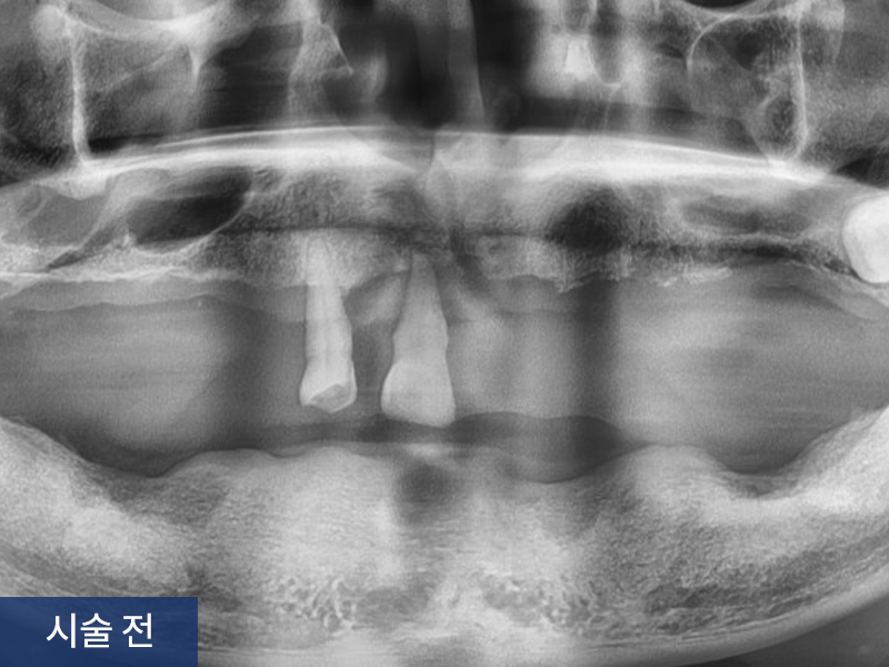 전악 임플란트 사례