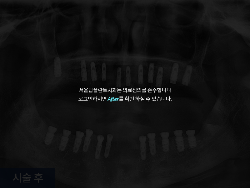 전악 임플란트 사례