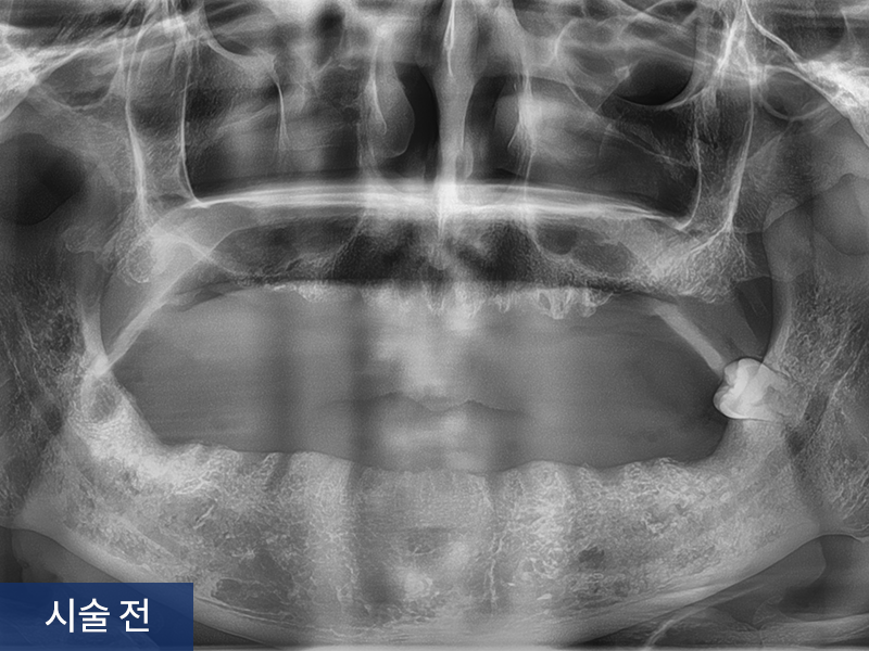 전악 임플란트 사례