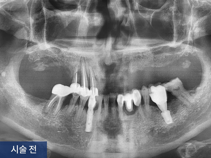 상악 임플란트 사례