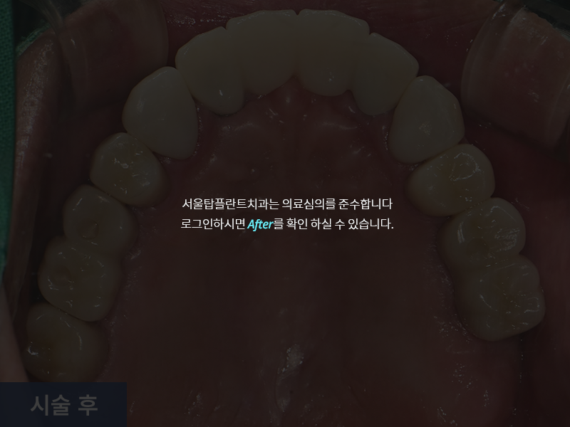 임플란트 사례 1