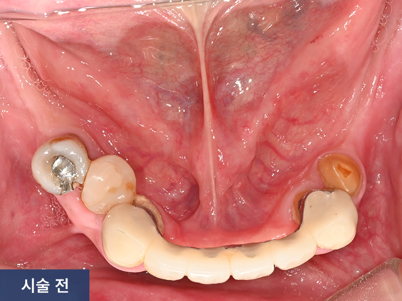 임플란트 사례 3