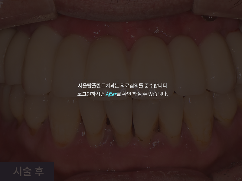 임플란트 사례 3