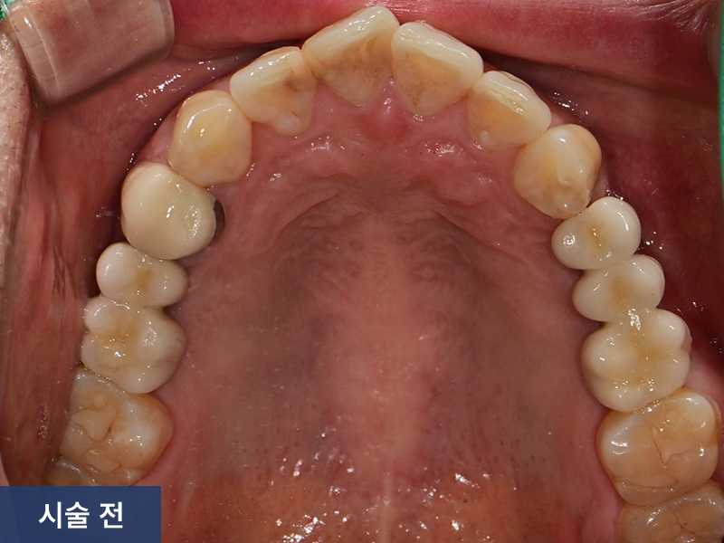 보철치료 사례 1