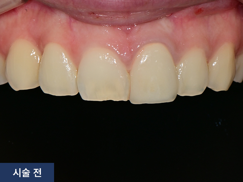 보철치료 사례 2