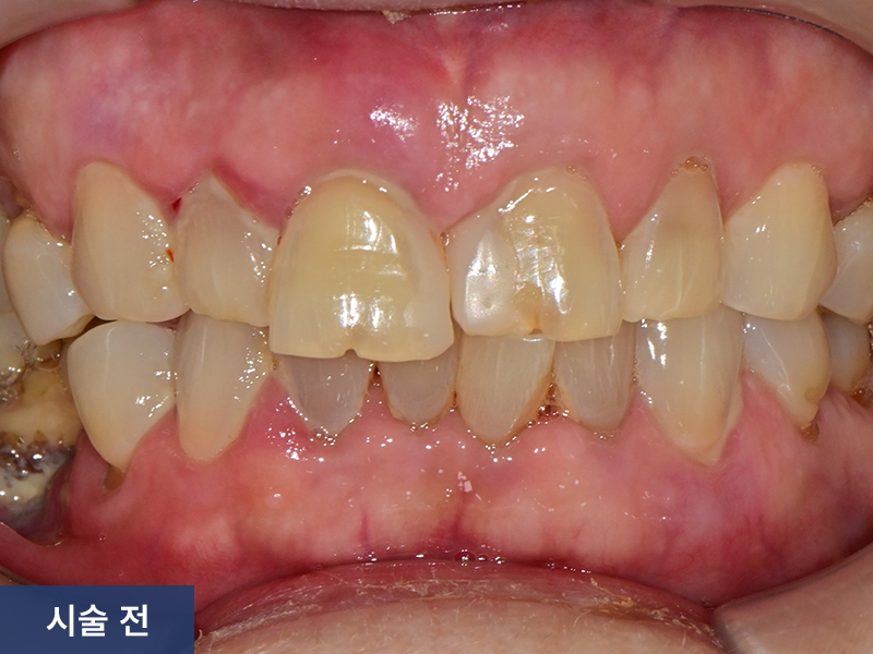 보철치료 사례 3