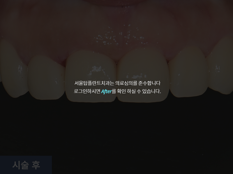 보철치료 사례 4