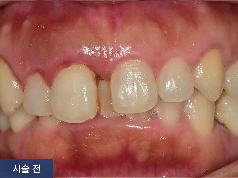 보철치료 사례 4