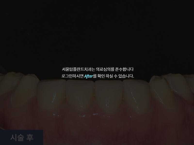 보철치료 사례 5