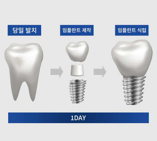 원데이 임플란트