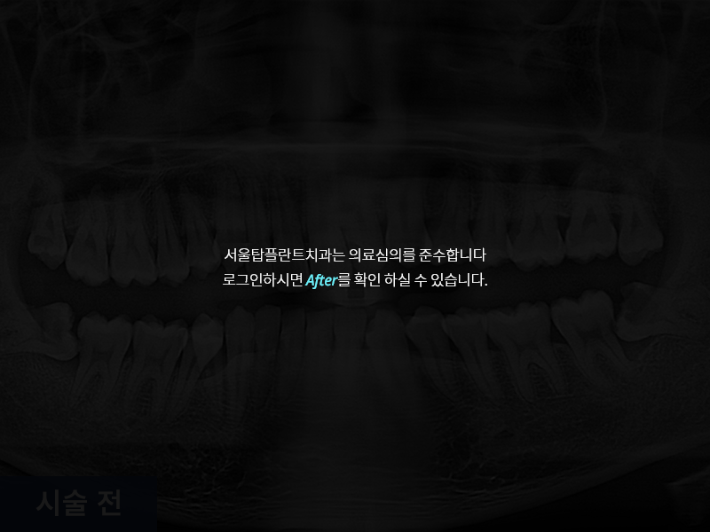 사랑니 발치 사례 1