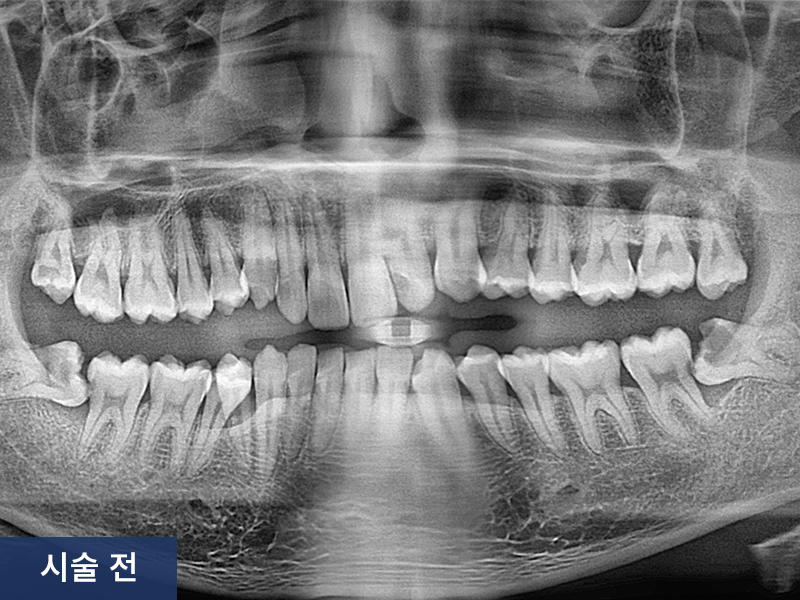 사랑니 발치 사례 1