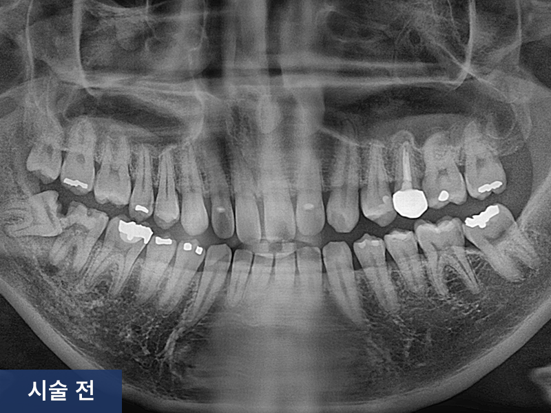 사랑니 발치 사례 2
