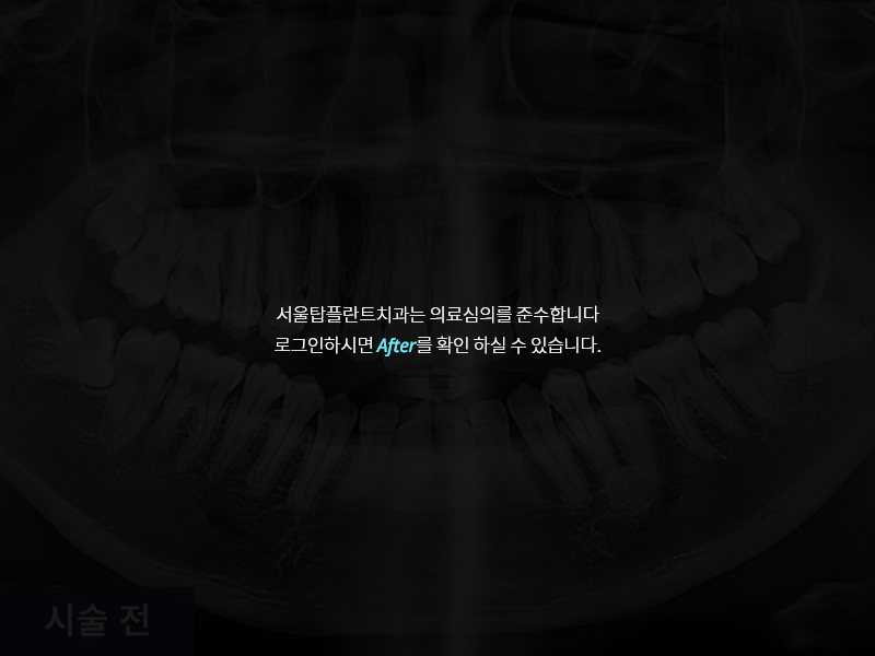 사랑니 발치 사례 3