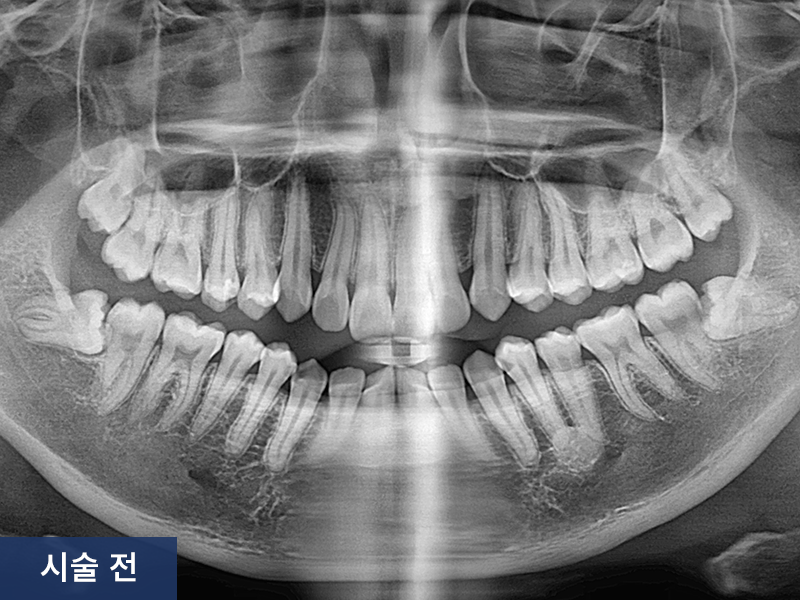 사랑니 발치 사례 3